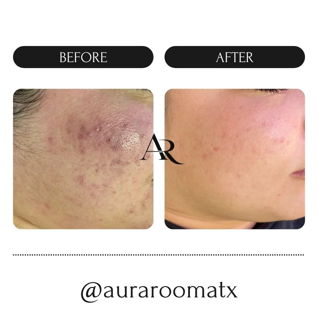 Close-up of cleared skin after Face Reality acne treatment with licensed esthetician in Round Rock, Texas.