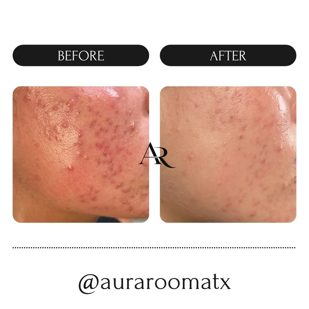Post-acne scarring and redness visibly reduced through professional treatments and Face Reality skincare at Aura Room in Round Rock, TX