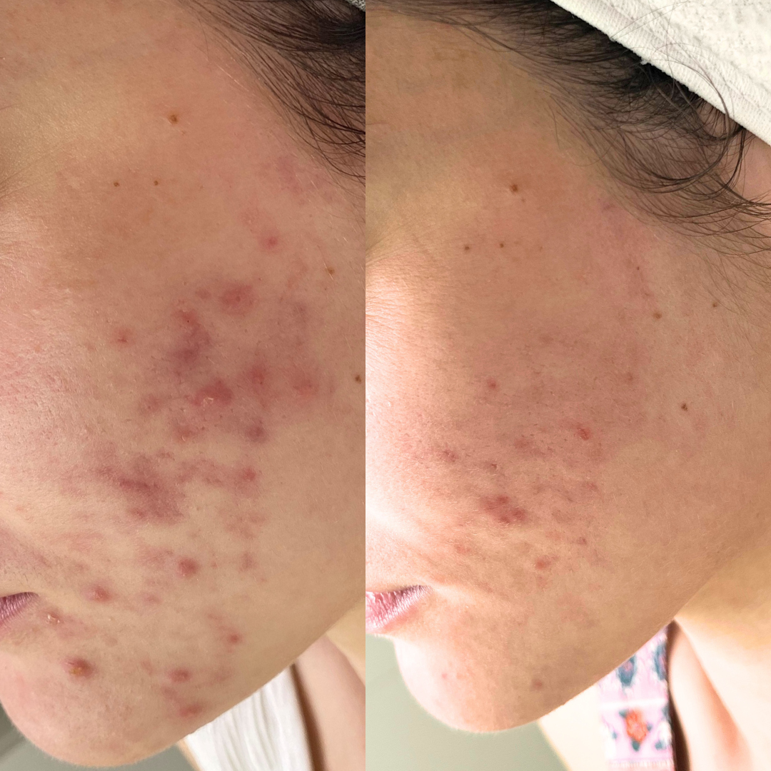 acne on side of cheek on face before and acne after skincare with less acne