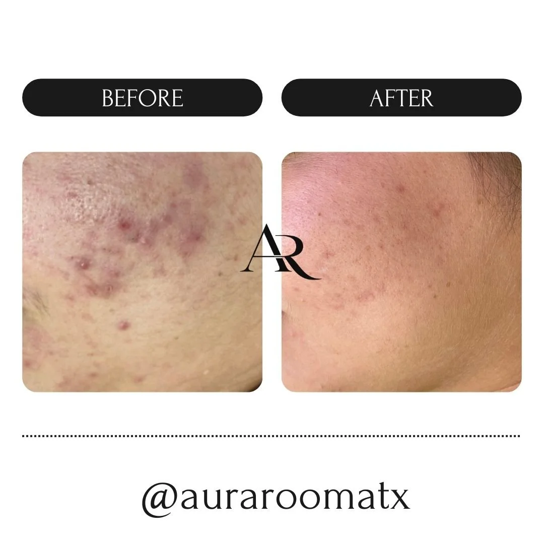 Active acne cleared after completing the Acne Clearing Program at Aura Room in Round Rock, TX using Face Reality's clear-skin system