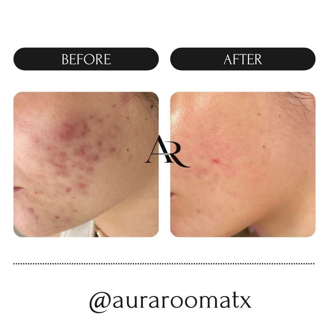 Severe cystic acne cleared with consistent biweekly treatments and a customized home care plan. Acne Clearing Program at Aura Room, Round Rock, TX.