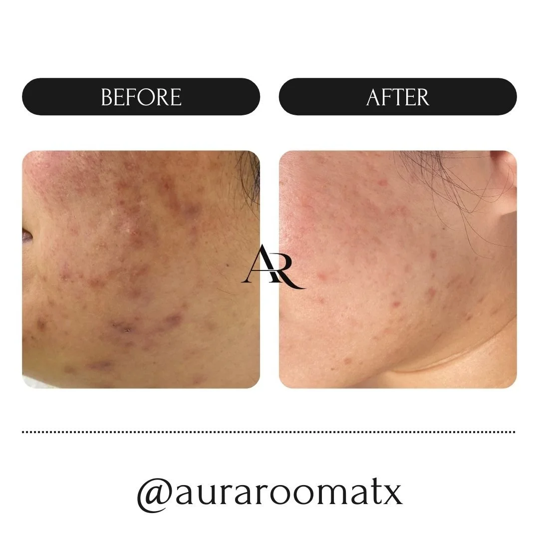 Before and after results of a 3-month acne clearing program at Aura Room in Round Rock, TX showing significant reduction in cystic acne on the cheek area