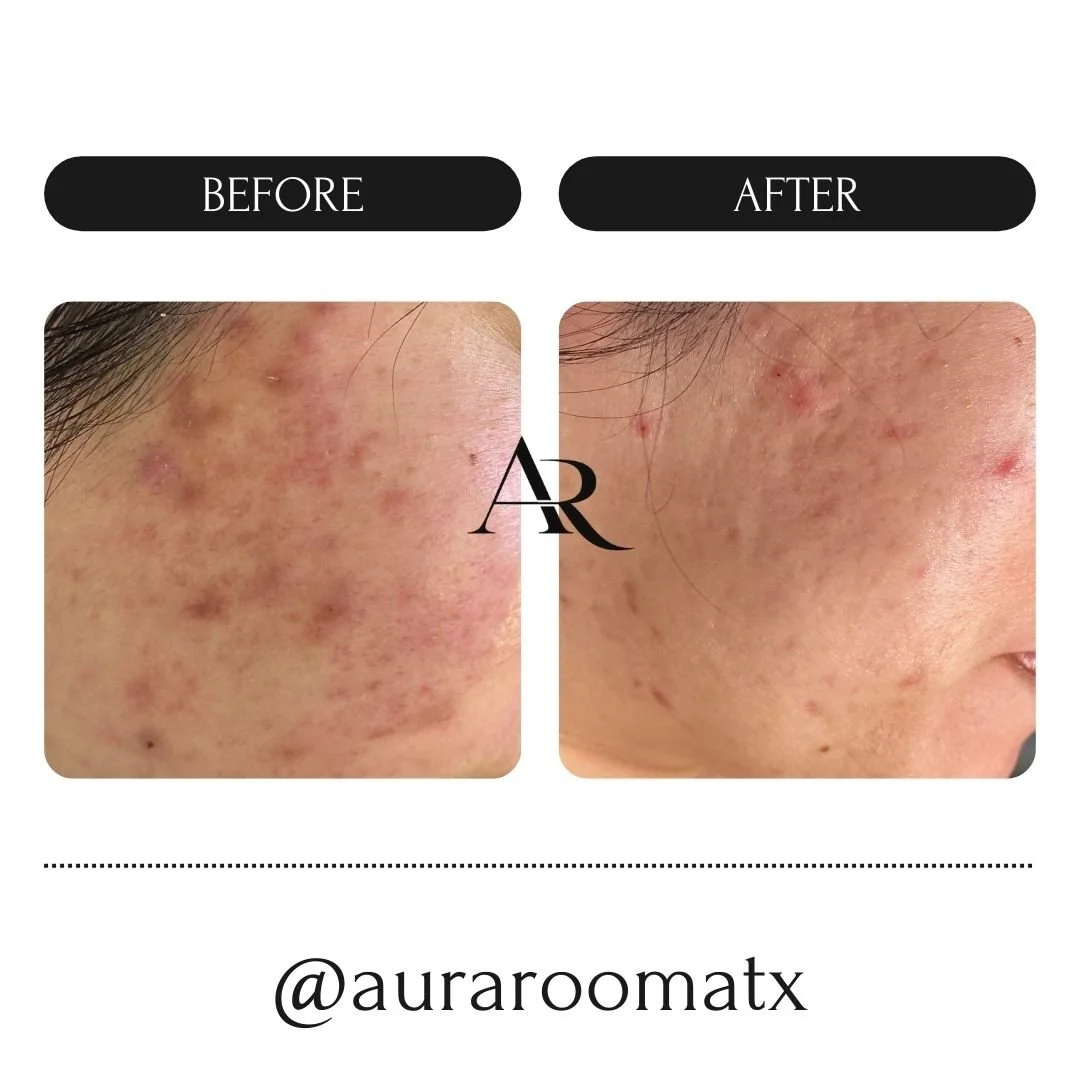 Before and after acne clearing results showing significant reduction in active breakouts on the cheek after Face Reality acne program at Aura Room in Round Rock TX