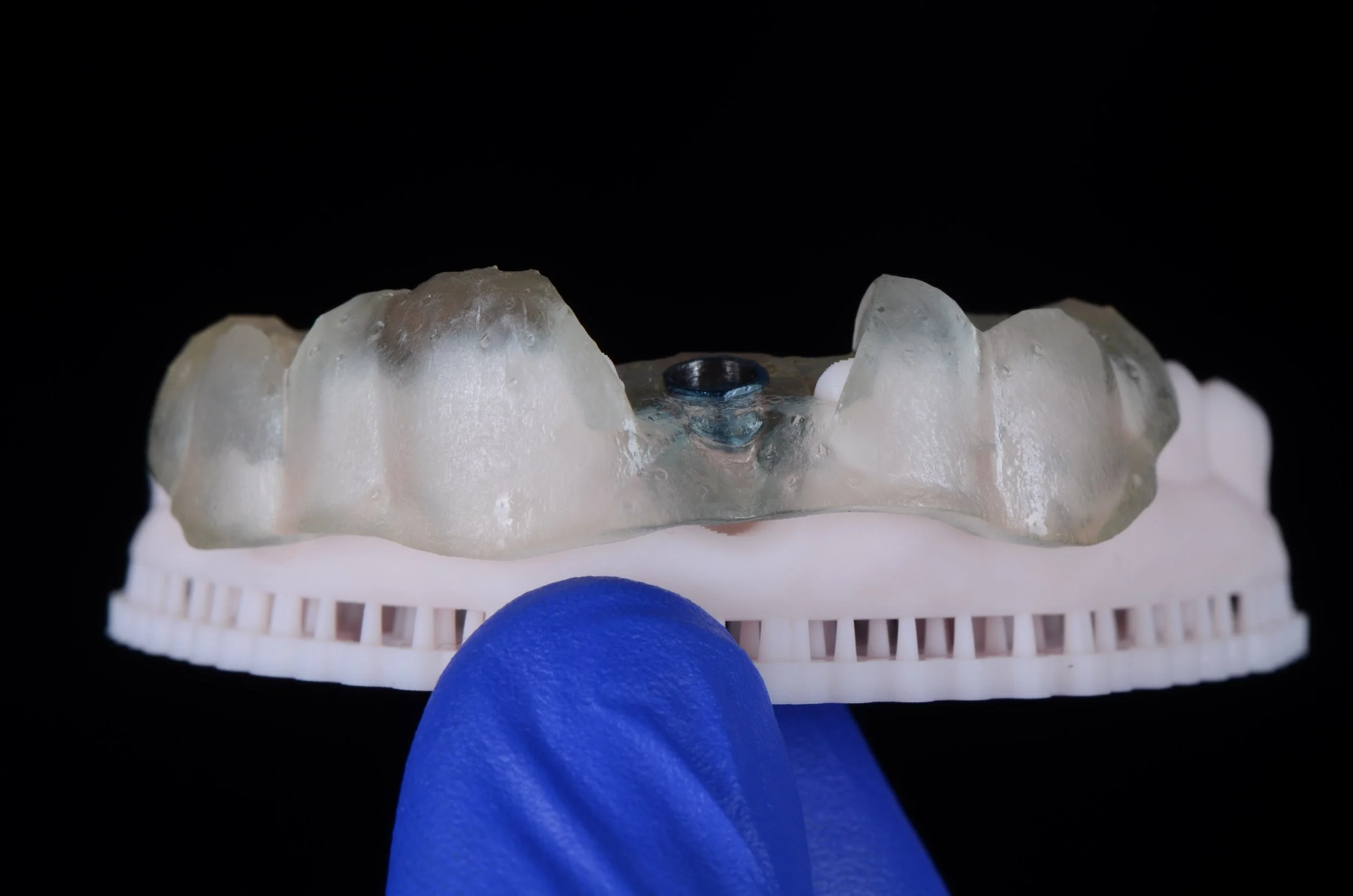 A dental prosthetic device, likely a dental implant model, with a titanium abutment visible in the center, held by a gloved hand against a black background.