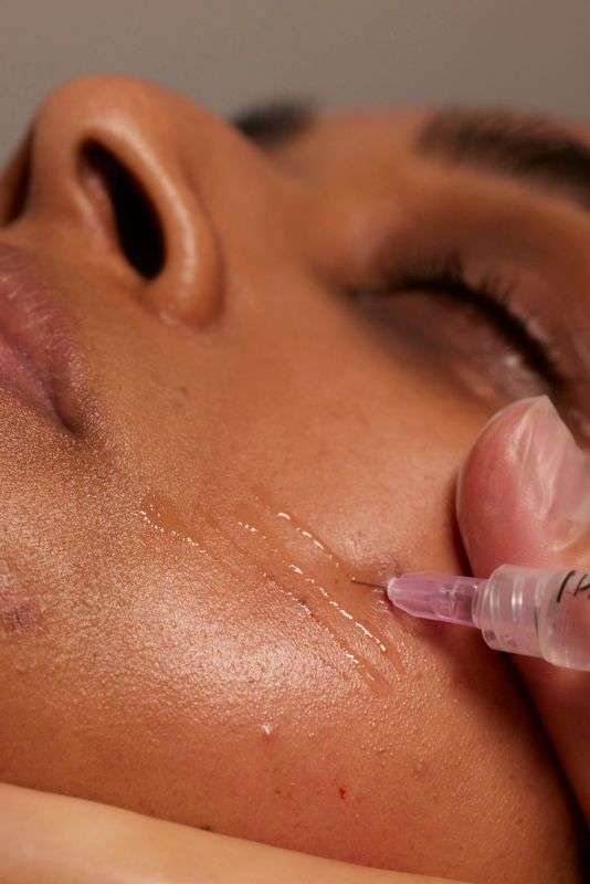 mesoterapia facial