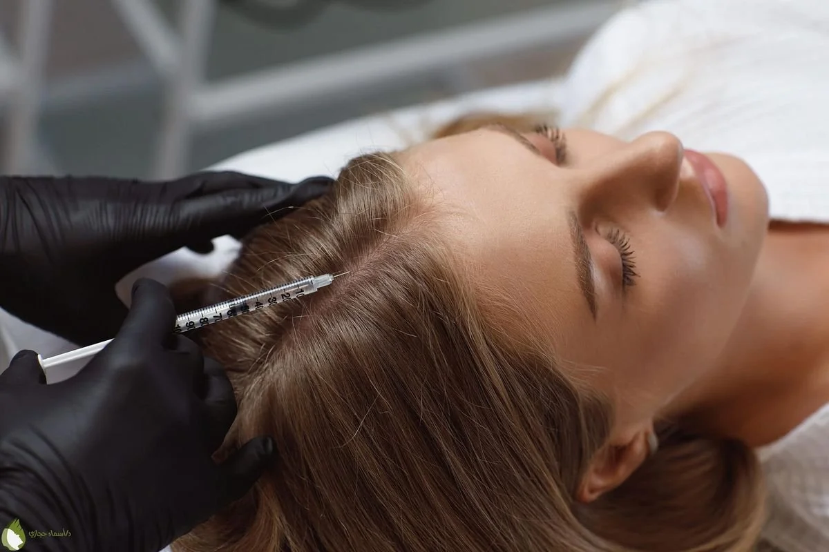 mesoterapia capilar