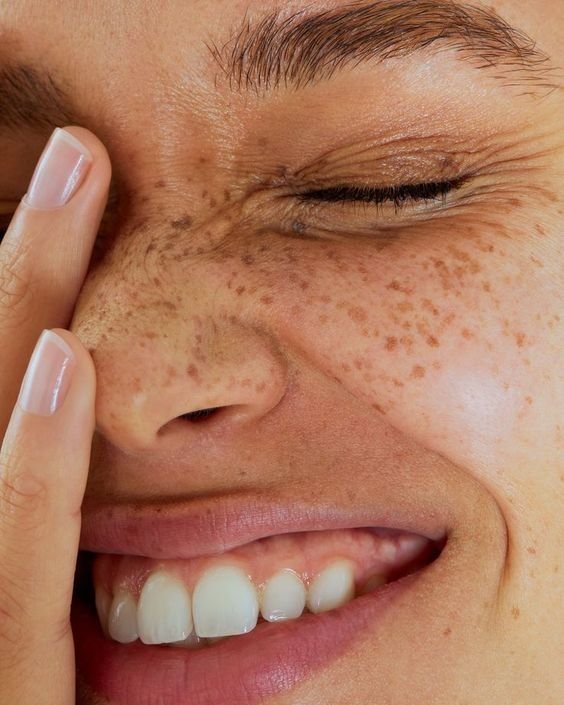 micropigmentacion pecas