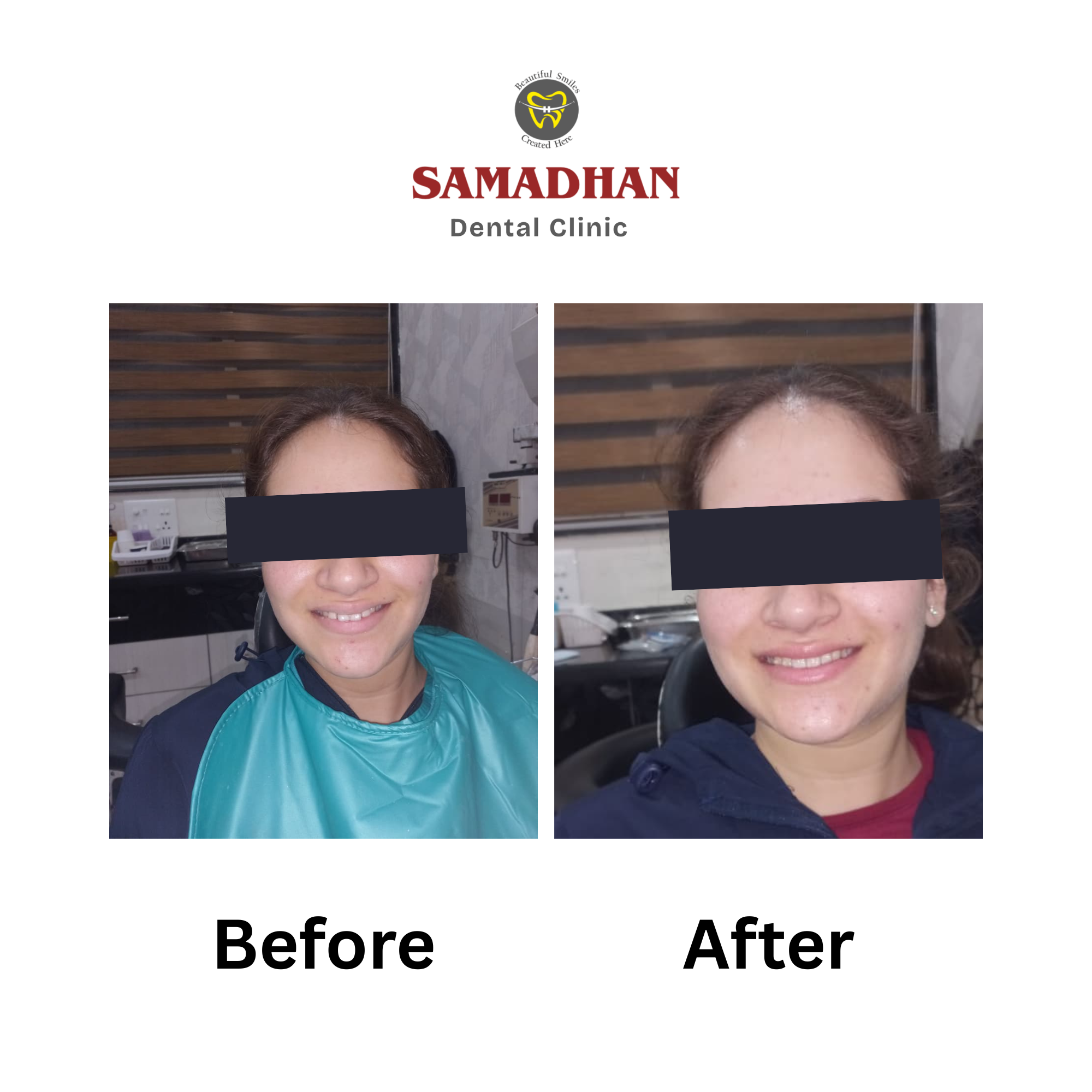 Braces transformation