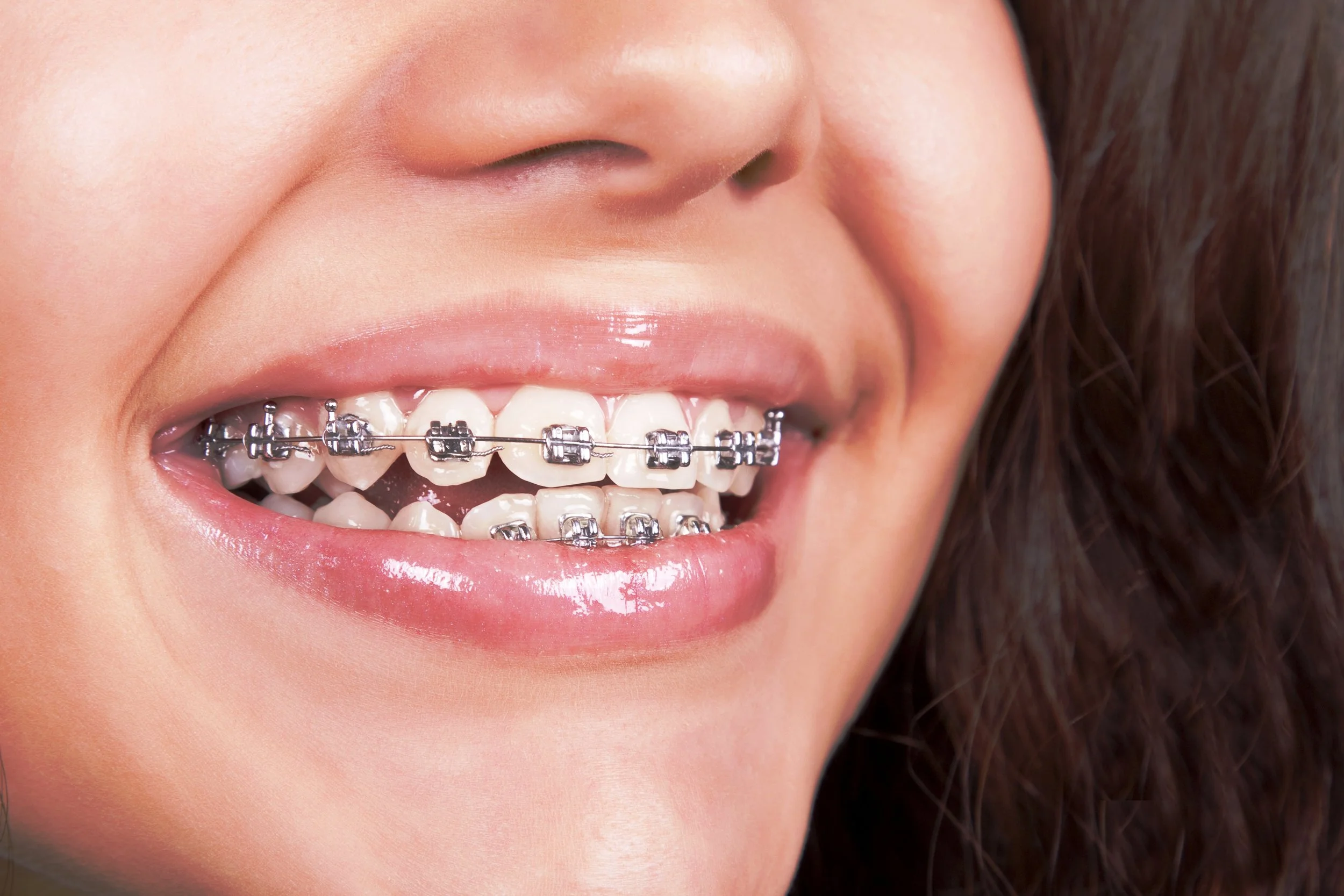dental-metal-braces