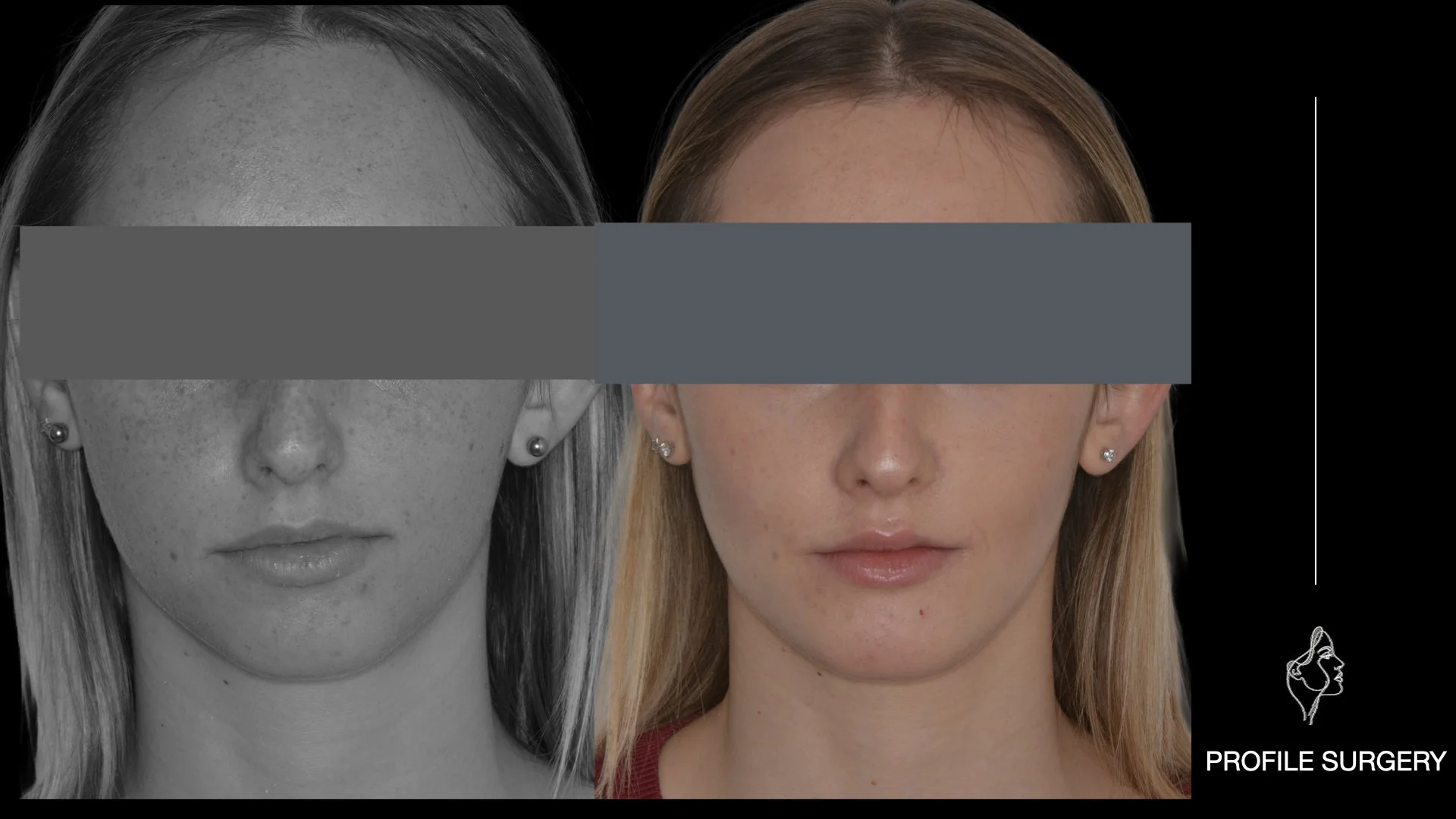 Immagine che mostra un confronto tra due fotografie di una donna, una in bianco e nero e l'altra a colori, con una linea verticale e un'illustrazione stilizzata del profilo di una donna in basso a destra, con la scritta 'PROFILE SURGERY'.