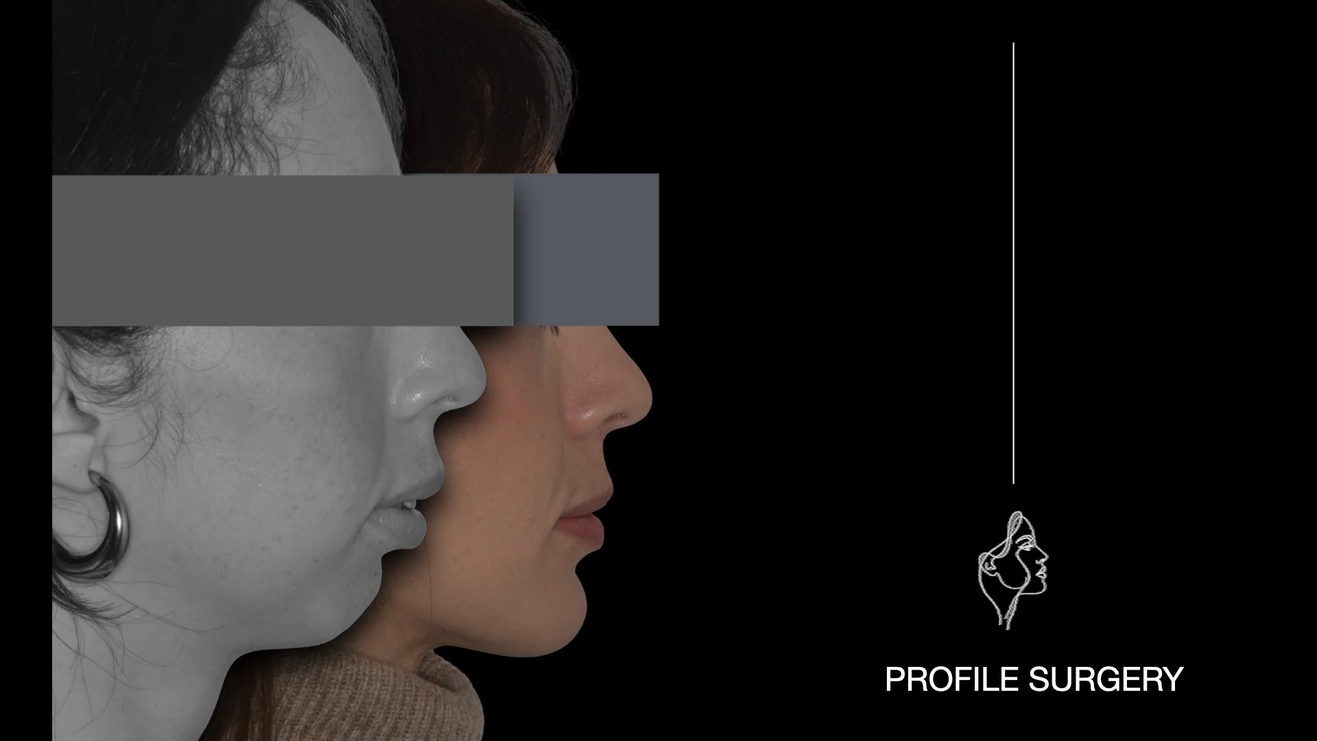 Immagine di un volto umano in profilo, mostrando un prima e dopo di chirurgia estetica del profilo, con una linea tracciata che evidenzia il profilo desiderato, e la scritta 'PROFILE SURGERY'.