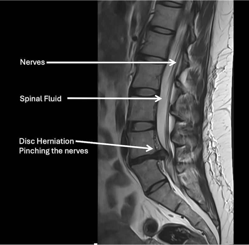 MRI scan of a lumbar spine showing nerve compression from a disc herniation pressing on the nerves, with labels indicating nerves, spinal fluid, and disc herniation pinching the nerves.