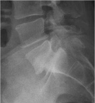 X-ray image showing spinal vertebrae and intervertebral discs.