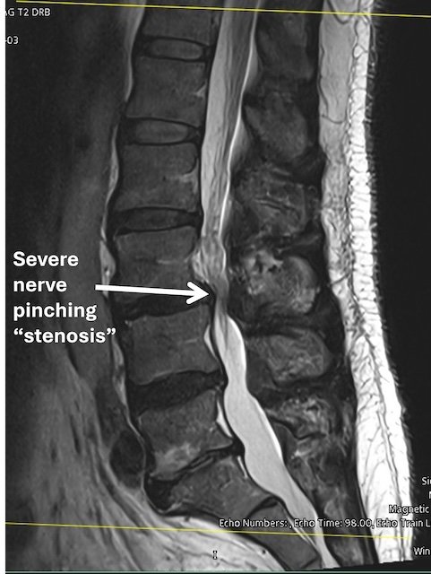 MRI scan showing severe nerve pinching or stenosis in the lumbar spine.