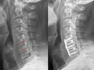 Comparison of spinal X-rays showing normal alignment on the left and surgical intervention with spinal hardware on the right.