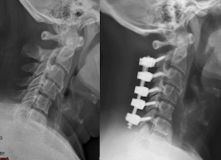 X-ray images of a neck showing a before and after comparison; the right side displays a cervical spine with surgical hardware indicating spinal fusion.