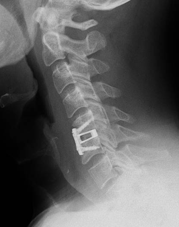 X-ray image of a human cervical spine showing a surgical implant and hardware.