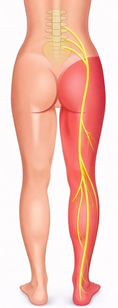 A diagram of the lower back and right leg showing the sciatic nerve from the spine to the leg, with the leg highlighted to indicate nerve pathway.