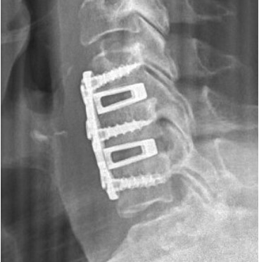 X-ray image of a spine with spinal hardware implant.