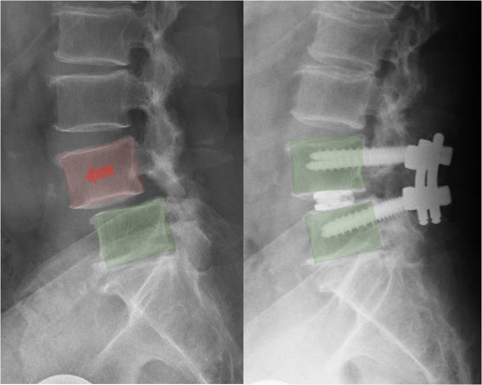 X-ray image showing a spine with spinal fusion hardware and highlighted areas indicating a herniated disc and spinal fusion screws
