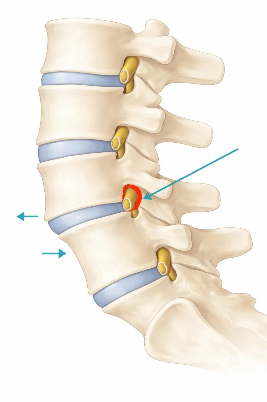 A diagram of human lumbar vertebrae showing a herniated disc highlighted in red, with arrows pointing to the herniation site.