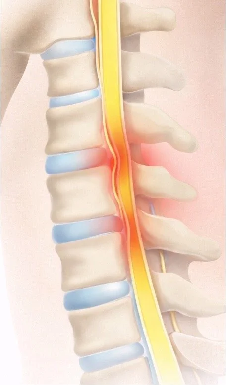 Medical illustration of a human spine showing a nerve pinch causing pain, with the affected area highlighted in red.