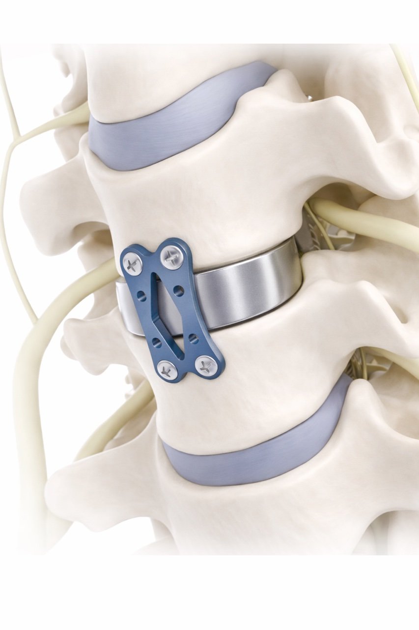 Model of human spinal vertebrae with a metal stabilization device and screws.