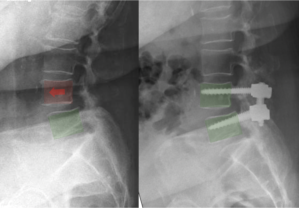 X-ray of cervical spine showing the placement of artificial disc implants with screws and a highlighted red area indicating a problem.