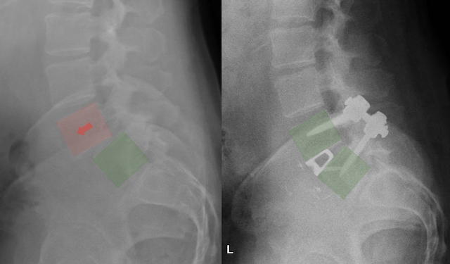 Comparison of two spinal X-rays, one with medical implants and markers highlighting features.
