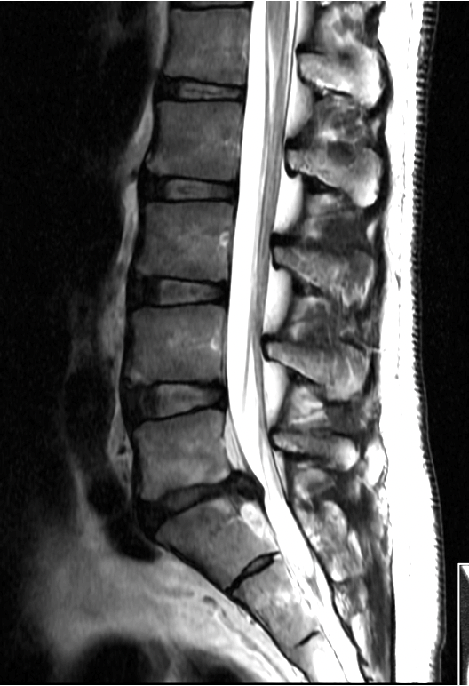 MRI scan showing side view of human lower spine and lumbar region.
