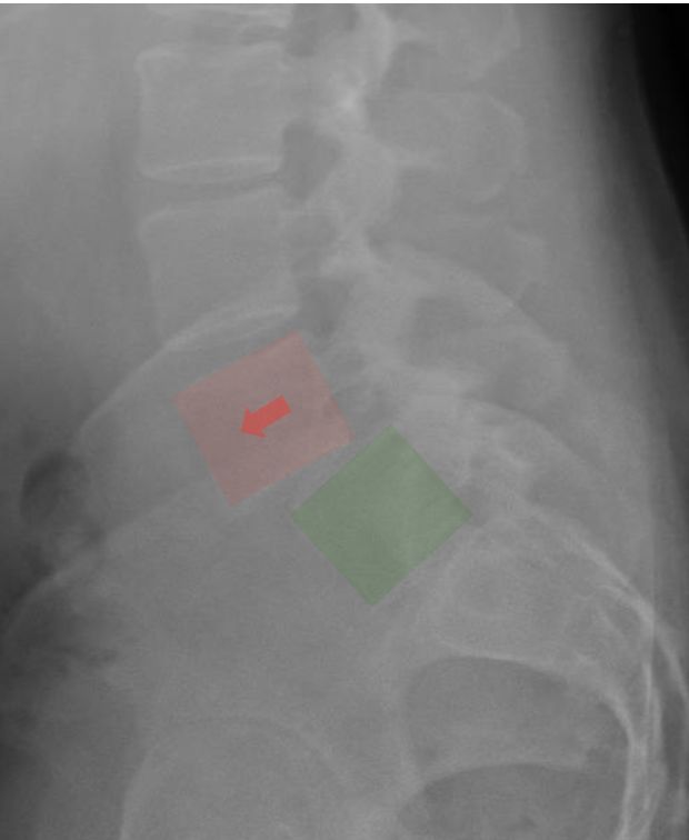 X-ray image of the lower spine showing a highlighted area with an arrow, with marked regions in red and green.