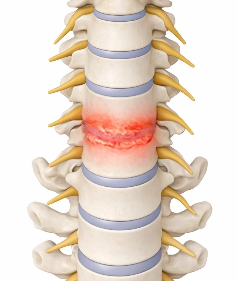 A detailed medical illustration of the human spine showing a section with inflammation and irritation, highlighted in red, around the lumbar vertebrae.