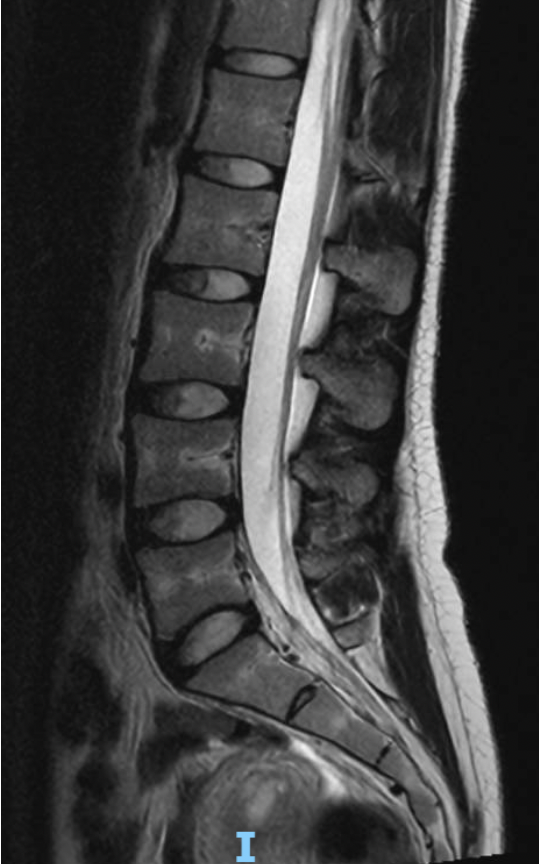 MRI scan of the human lower back spine showing vertebrae, spinal cord, and surrounding tissues in black, white, and gray shades.