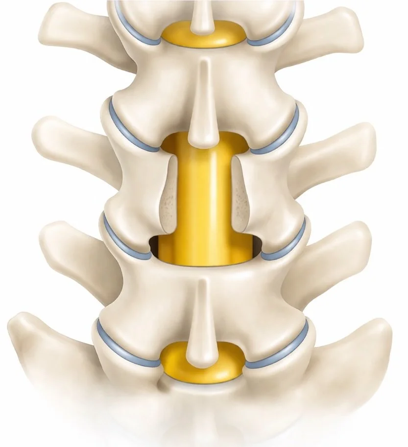 A detailed illustration of three vertebrae from the human spine showing intervertebral discs, spinal cord, and nerves.