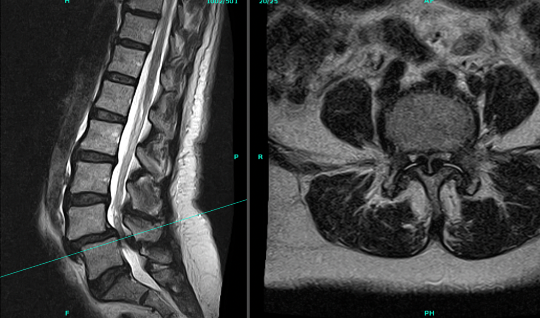 MRI scans showing images of the lower spine and a cross-section of the pelvis.
