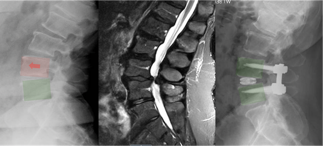 Medical images showing spinal imaging with disc replacement devices and spinal alignment.