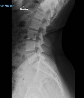 Lateral X-ray of the cervical spine showing vertebrae, intervertebral discs, and spinal alignment.