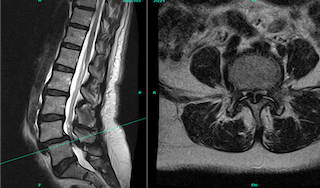 MRI scans showing a side view and a cross-section of the lumbar spine and lower back pelvis area.
