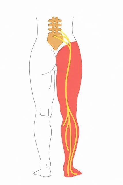 Diagram of the sciatic nerve running from the lower back through the buttock and down the back of the leg, highlighted in yellow.