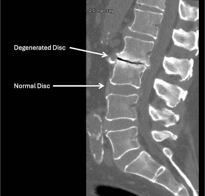 A lumbar spine X-ray showing a normal disc and a degenerated disc with labels pointing to each.
