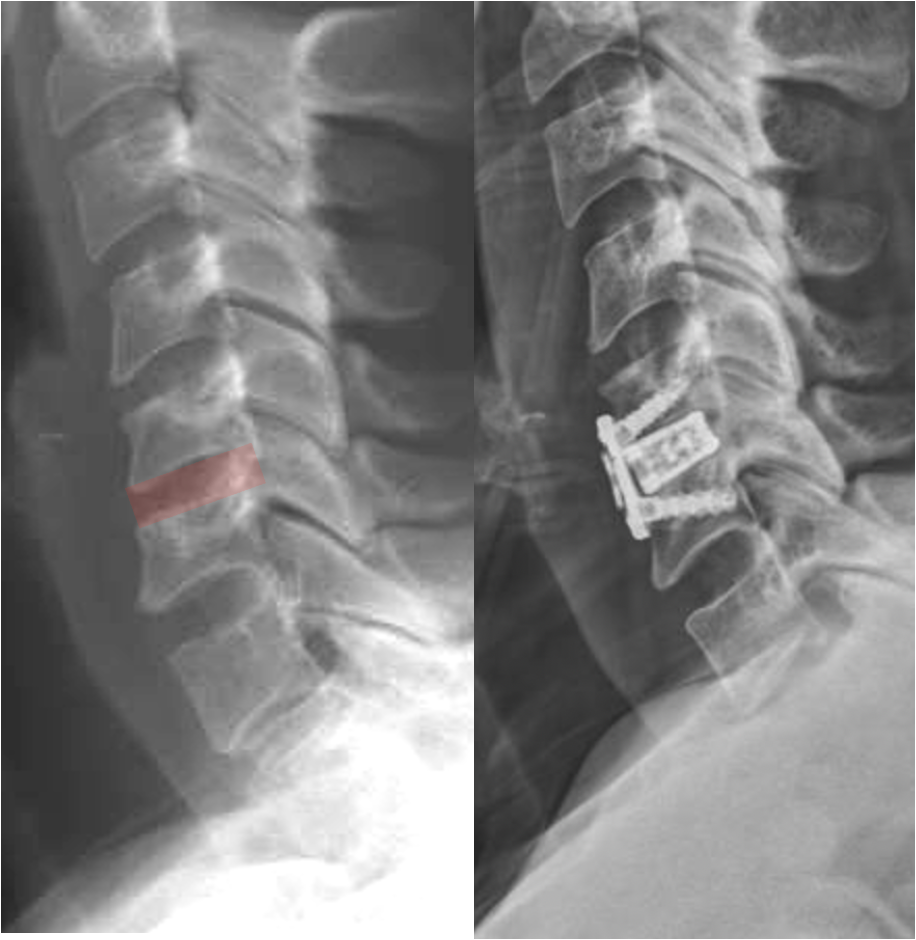 X-ray images of a human cervical spine showing a herniated disc before and after spinal surgery with hardware implanted.