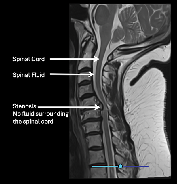 MRI scan showing a side view of the spine with labels pointing to the spinal cord, spinal fluid, and an area of stenosis with no fluid surrounding the spinal cord.
