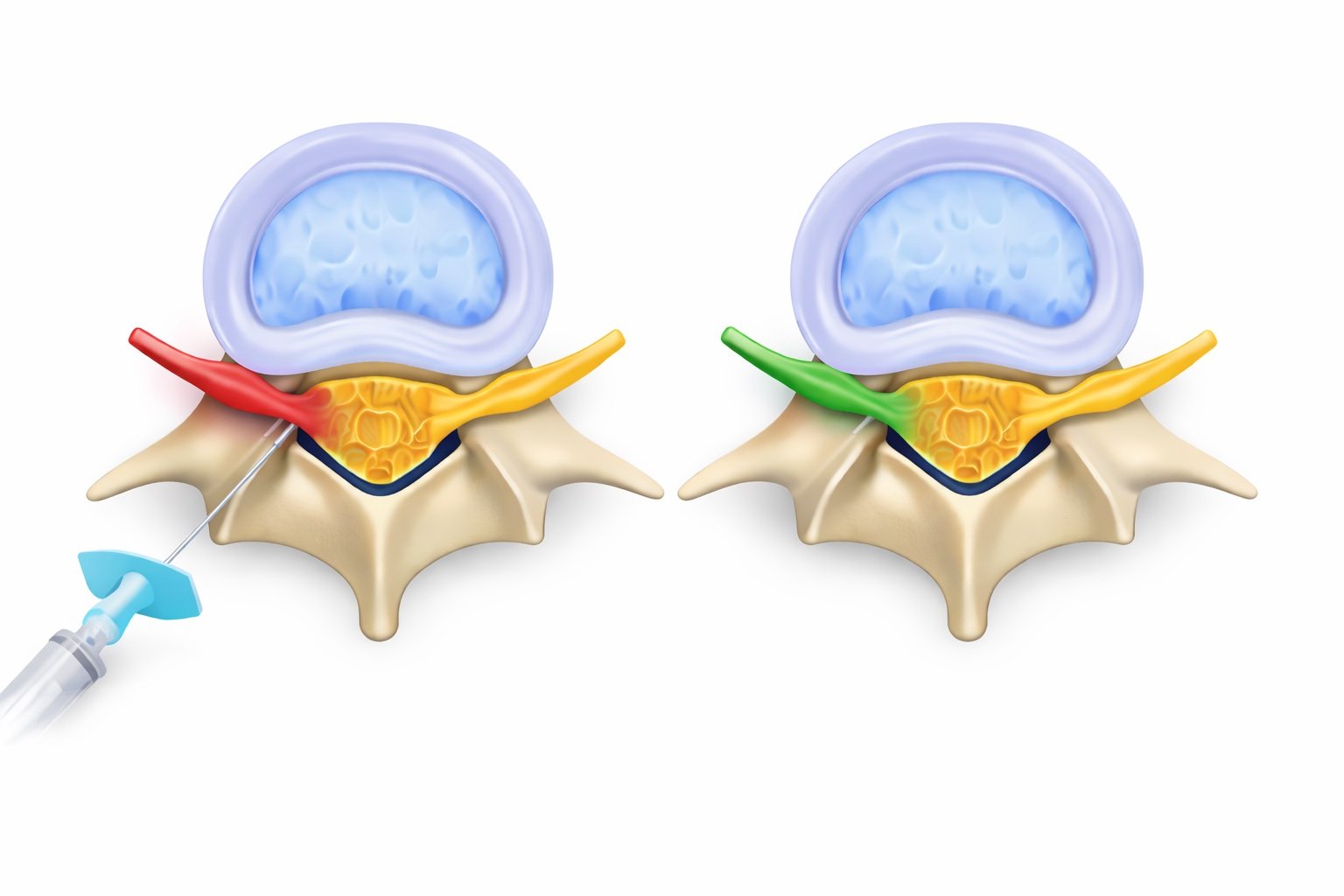 Diagram of two vertebrae connected by a disc, showing a procedure with a needle injecting into the left side, with the right side intact. The left side has red and yellow nerves, while the right has green and yellow nerves.