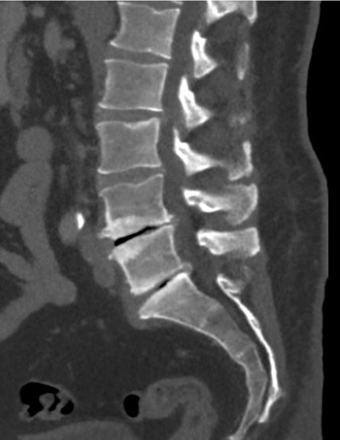 MRI scan of the lumbar spine showing vertebrae, discs, and spinal canal with a herniated disc pressing on the nerve.