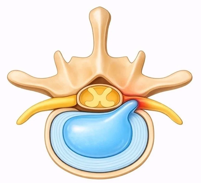 Diagram of a spinal disc with nerve roots, showing the disc pressing on nerves.