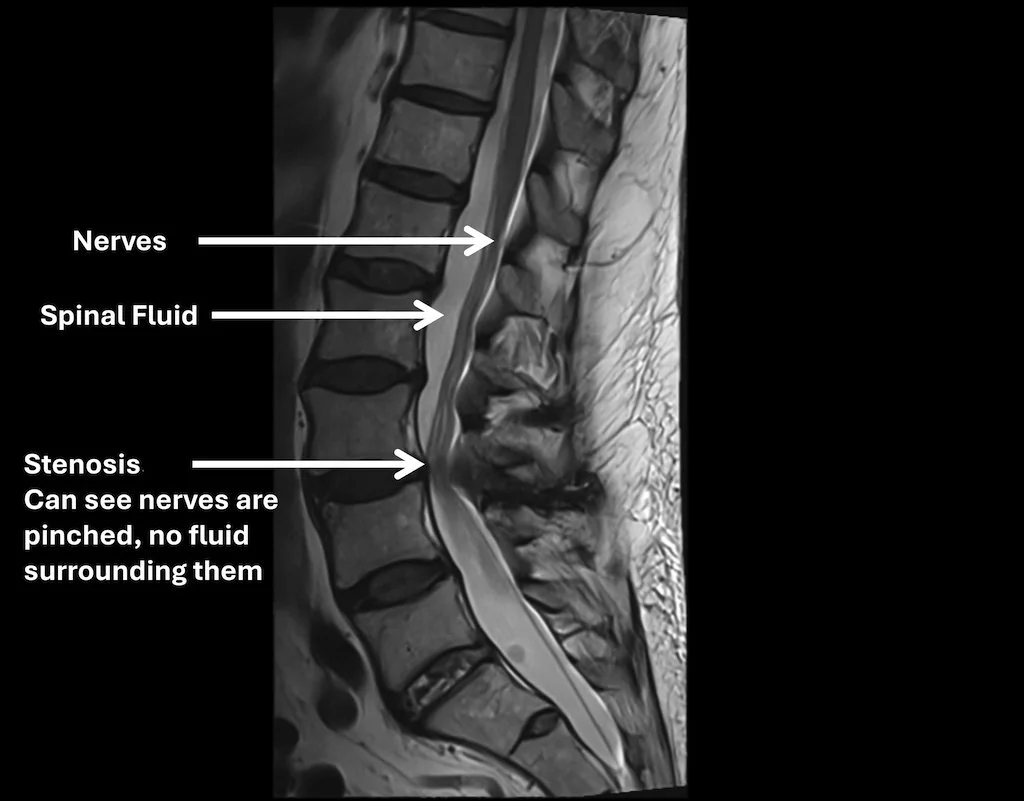 MRI scan of the lower spine showing nerves, spinal fluid, and stenosis. Nerves are pinched with no fluid surrounding them.