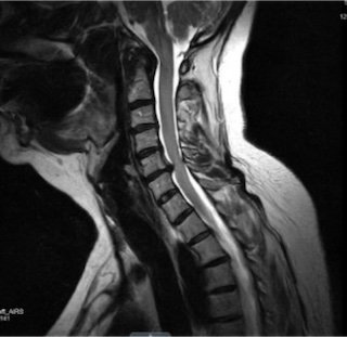 MRI scan of a human spine showing vertebrae and spinal cord.