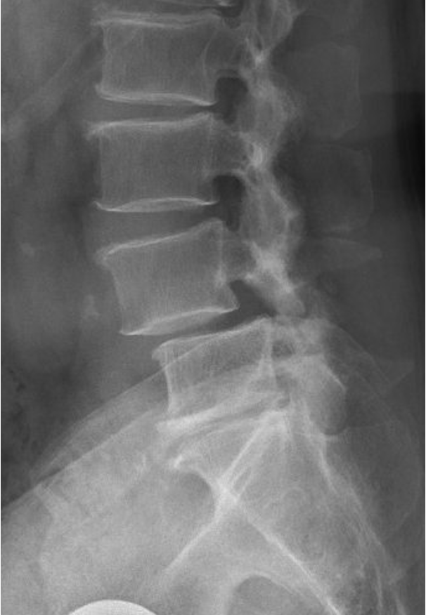 X-ray image of a human lumbar spine showing vertebrae and discs.