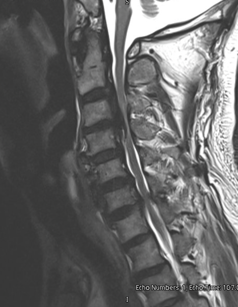 MRI scan of a human lumbar spine showing vertebrae, intervertebral discs, and spinal cord.