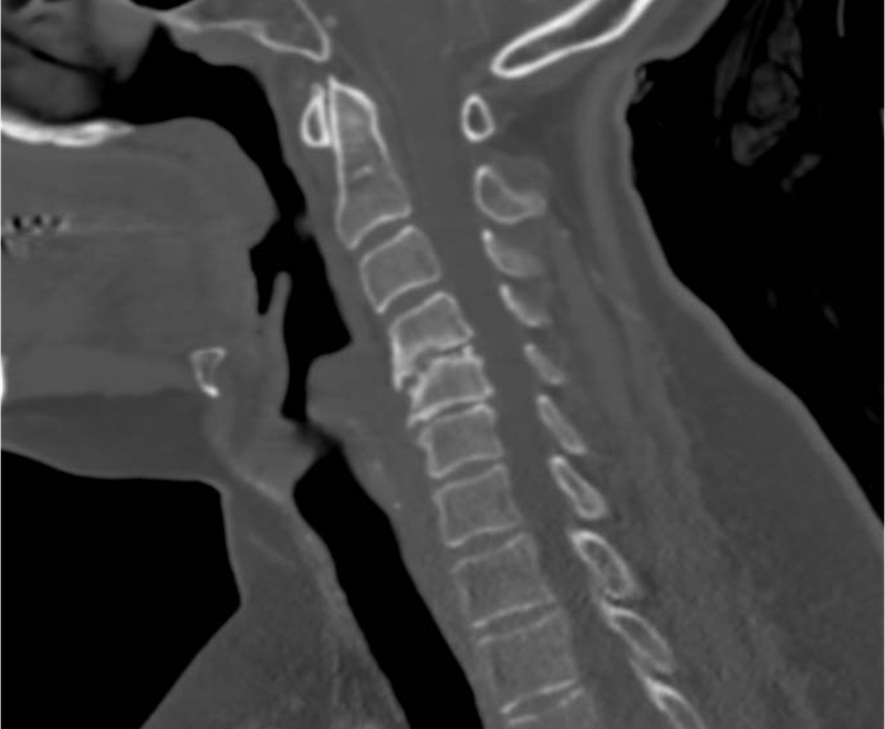 CT scan image of a human neck showing cervical vertebrae and surrounding tissues.